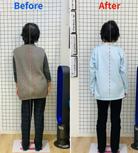 （側弯症）所沢市　K様